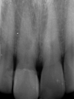 Radiografia de controlo aos 9 meses – lesão radiolúcida arredondada no terço cervical da raiz do dente 11.