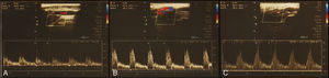 Imagem ultrassonográfica com Doppler de carótidas apresentando estenose inferior a 50% na carótida interna direita (A), nos bulbos carotídeos direito (B) e esquerdo (C).