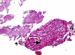 Características histopatológicas da lesão, mostrando epitélio odontogénico, com presença de célula fantasma, indicada pela seta (HE, 400X).