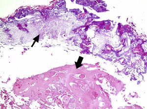 Aspectos histopatológicos do odontoma associado à lesão, mostrando depósitos de esmalte (seta fina) e material dentinoide (seta grossa) (HE, 200X).