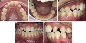 Intraoral photographic status (A) upper occlusal, (B) lower occlusal, (C) right side, (D) front side, (E) left side.