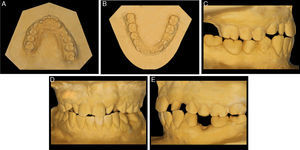 Dental casts (A) upper occlusal, (B) lower occlusal, (C) right side, (D) front side, (E) left side.