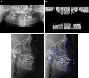 Diagnostic records (A) panoramic X-ray, (B) periapical radiographs, (C) cephalometric radiography, (D) ricketts cephalometric tracing.