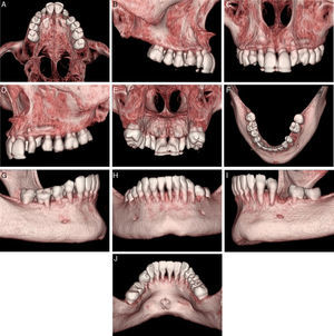 Computed tomography, 3D reconstruction – upper (A) occlusal, (B) right side, (C) front side, (D) left side, (E) posterior side and lower, (F) occlusal, (G) right side, (H) front side, (I) left side, (J) posterior side.