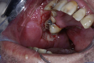 Úlcera extensa envolta por eritema, com bordas irregulares, edemaciada com aspecto moriforme, em mucosa jugal, lábios, palato duro, fundo de sulco e mucosa alveolar do lado direito.