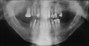 Área radiolúcida em região alveolar com extensão para o túber nas áreas entre os dentes 16 e 15, e lesão circunscrita radiolúcida no dente 13.