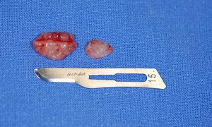 Aspecto macroscópico das peças removidas na biópsia incisional.