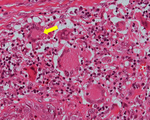 Inflamação granulomatosa caracterizada por células gigantes multinucleadas do tipo Langhans, algumas com o fungo em seu interior (seta amarilla) (hematoxina e eosina 40×).