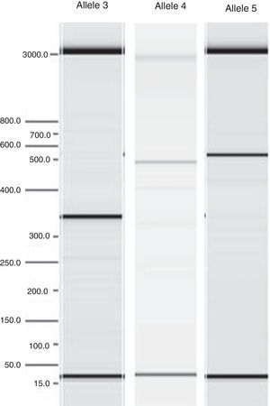 Electrophoretic representation of PCR products and detection of alleles 3, 4 or 5 of IL1RN.