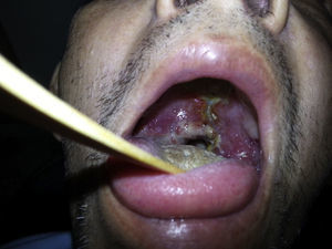 Aspeto clínico: lesão necrosante em palato duro, com destruição de úvula e lesões granulomatosas.