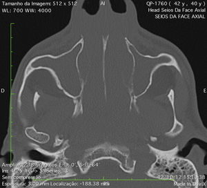 Tomografia computadorizada dos seios paranasais: corte axial mostrando lesão expansiva ocupando seios esfenoidais com extensão para rinofaringe.