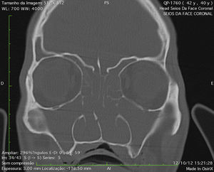 Tomografia computadorizada dos seios paranasais: corte coronal mostrando lesão expansiva ocupando seios maxilares e etmoidais, assim como cavidade nasal com desvio do septo nasal para direita.