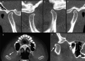 Cortes transversais oblíquos da região da ATM do lado direito em máxima intercuspidação habitual (MIH) (A) e máxima abertura de boca (MA) (B), e do lado esquerdo em MA (C) e MIH (D). Vistas axial (E) e sagital (F) demonstrando a presença do osteófito no côndilo mandibular direito (seta) e o aplainamento dos côndilos mandibulares.