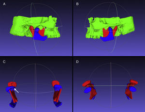 Côndilos mandibulares do lado direito (A) e do lado esquerdo (B), em MIH (vermelho) e MA (azul), alinhados e sobrepostos. Vista frontal dos côndilos mandibulares (C) e alteração morfológica indicativa de osteófito no côndilo direito (seta). Vista superior dos côndilos mandibulares (D).