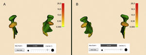 Análise quantitativa através dos mapas de codificação coloridos e da ferramenta «Point Value». Vista superior do côndilo mandibular direito (A) e do côndilo mandibular esquerdo (B). Côndilos mandibulares em MIH (verde) e MA (colorido).