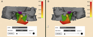 Análise quantitativa por meio dos mapas de codificação coloridos e da ferramenta «Point Value». Vista lateral dos côndilos mandibulares direito (A) e esquerdo (B). Côndilos mandibulares em MIH (verde), MA (colorido), e eminência articular (roxo).