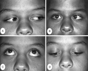 Extraocular movement the right eye 2min after dental anesthesia. (A) Adduction; (B) Abduction missing; (C) Elevation; (D) Depression.