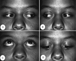 Extraocular movement of the right eye 2h after dental anesthesia. (A) Adduction; (B) Abduction; (C) Elevation; (D) Depression.