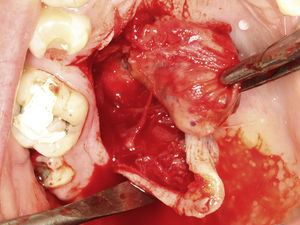 Imagem transcirúrgica, mostrando exérese de lesão bem delimitada, que foi facilmente destacada da mucosa adjacente.