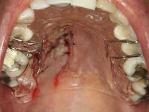 Imagem do dispositivo de acrílico colocado imediatamente após realização da sutura, para proteção da área submetida à cirurgia.