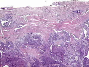 Exame histopatológico, mostrando neoplasia delimitada por cápsula de tecido conjuntivo fibroso (HE, 40X).