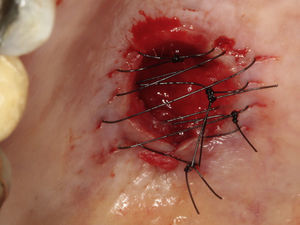 Loca cirúrgica e sutura após excisão cirúrgica.