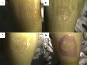 (A) score 0: without remnant composite on the tooth, (B) score 1: less than 50% remnant composite on the tooth, (C) score 2: over 50% remnant composite on the tooth, (D) score 3: all the composite on the tooth, with a distinct impression of the bracket supporting screen.