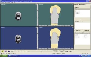 A interface do utilizador do sistema PREPassistant® para a série de modelos tipo 1 e 1A na perspectiva mesial‐distal. As imagens mostram o emparelhamento dos modelos original‐instrutor‐aluno e respetivas grelhas de avaliação.