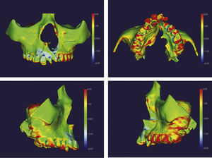 Mapa por código de cores do tratamento com o aparelho em leque. O vermelho presente em molares, pré‐molares, caninos e incisivos indica expansão. O azul na região cervical de alguns dentes indica uma possível deflexão decorrida devido à projeção vestibular desses dentes.