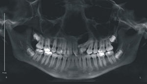 Radiografia panorâmica da paciente A, antes da instalação do aparelho em leque.