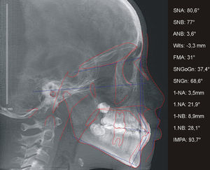 Radiografia e cefalograma em norma lateral da face, da paciente A, antes da instalação do aparelho em leque.