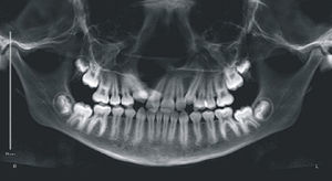Radiografia panorâmica do paciente B, antes da instalação do aparelho mini‐Hyrax invertido com BTP.