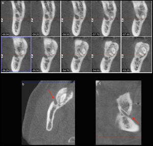 Parasagittal view (a), axial view (b), and sagittal view (c) of mandibular canal fenestration on the right side of the mandible.