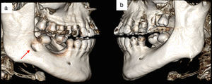Comparison between right side (a) and left side (b) of the mandible in a 3D reconstruction.
