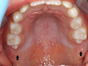 Exame intraoral inicial do maxilar superior. Dentes 16 e 26 não erupcionados (setas).