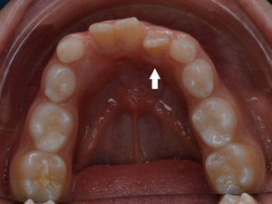 Exame intraoral inicial do maxilar inferior. Dente 32 lingualizado (seta branca).