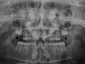 Ortopantomografia antes do tratamento. Dentes 16 e 26 não erupcionados (setas). Agenesia dos dentes 14, 15, 17, 18, 24, 25, 27, 28, 34, 35, 37, 38, 44, 45, 47, 48.