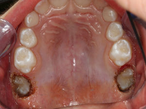 Exposição dos dentes 16 e 26, após gengivectomia com laser díodo (980nm).