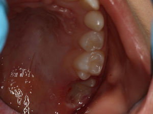 Follow‐up de uma semana. Primeiro molar superior direito parcialmente visível após cirurgia laser.