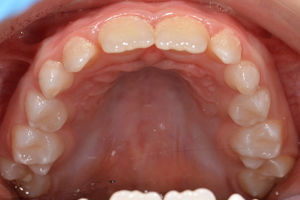 Follow‐up de 3 meses. Dentes 16 e 26 presentes na arcada e com selantes de fissuras.