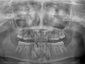 Ortopantomografia de controlo 9 meses após cirurgia. Dentes 16 e 26 erupcionados.