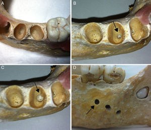 Dried human mandibles (gold standard). Healthy alveolus without preparation (A); arrows indicating an alveolus following the production of a periapical diseases with #6 drill (B), #10 drill (C), and rupture of the buccal cortical bone (D).