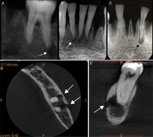 Arrows indicating radiolucent images simulated with different drill sizes. Lesion associated with the root apex of the lower left first molar, using a CCD sensor (A), and of the lower incisors, using a PSP system (B) and CPR (C). Arrows indicating radiolucent images associated with the root apex and rupture of the buccal cortical bone, in the axial (D), and sagittal view of high-resolution CBCT (E).