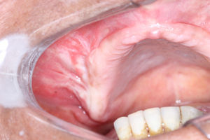 Clinical aspect: swelling on right alveolar ridge.