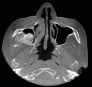 Image exam of the lesion: computed tomography scan with axial view, showing lesion protruding into the right maxillary sinus.
