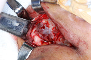 Surgical site: intraoperative view of the surgical site after the procedure on right alveolar ridge.