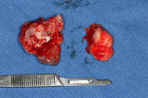 Surgical aspect of the specimen: view of the gross surgical specimen after excisional biopsy.