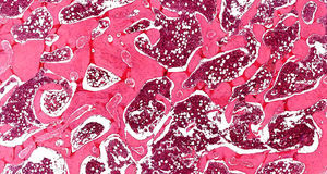 Histologic features: hematopoietic bone marrow associated with fatty cells and trabeculae bone (H&E, ×100).