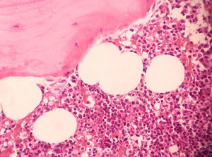 Histologic features: hematopoietic bone marrow associated with fatty cells and trabeculae bone (H&E, ×400).