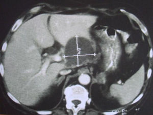 Imagem de tomografia axial computorizada abdominal. Observa-se um volumoso abcesso hepático perihilar com cerca de 7cm de diâmetro.